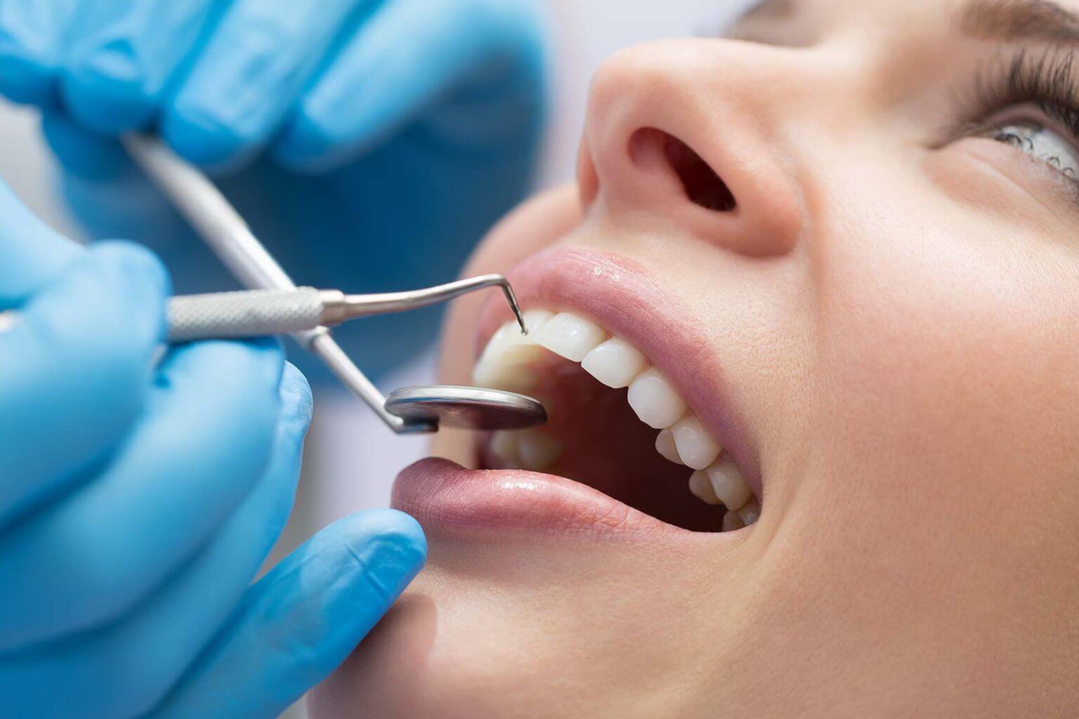 Dental Bonding – Warsaw, IN - Dental Solutions