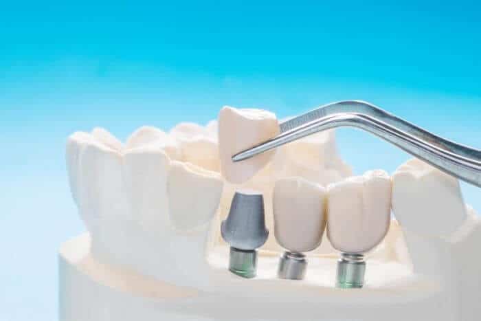 Dental Implants Peachtree City GA
