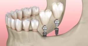 Dental implant for missing teeth replacement