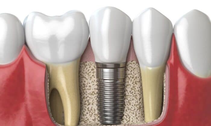Implants Dentistry Peachtree City
