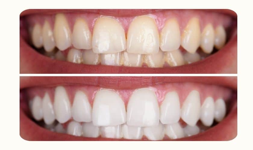 teeth whitening treatment peachtree city